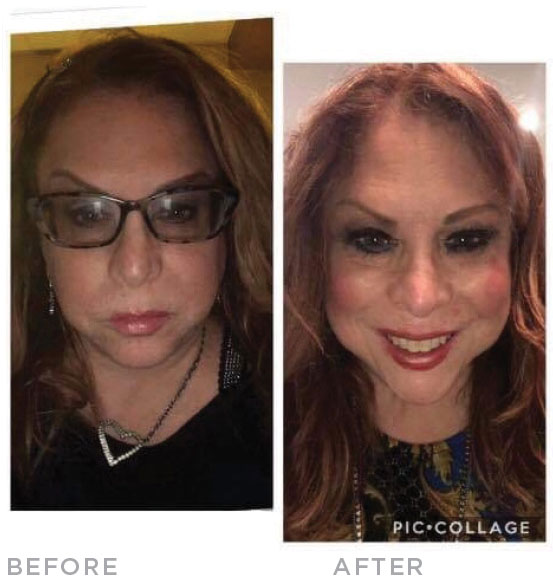 melanie-before-after